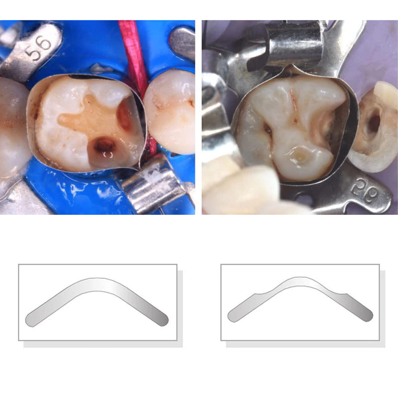 Dental Tofflemire Matrix Bands, Dental Matrix Bands, Stainless Steel Matrix Bands, Gingival Wall Lift and Large Curvature Sectional Contoured Matrices. (40PCS I1 Gingival Wall Lift) 40PCS I1 Gingival wall lift