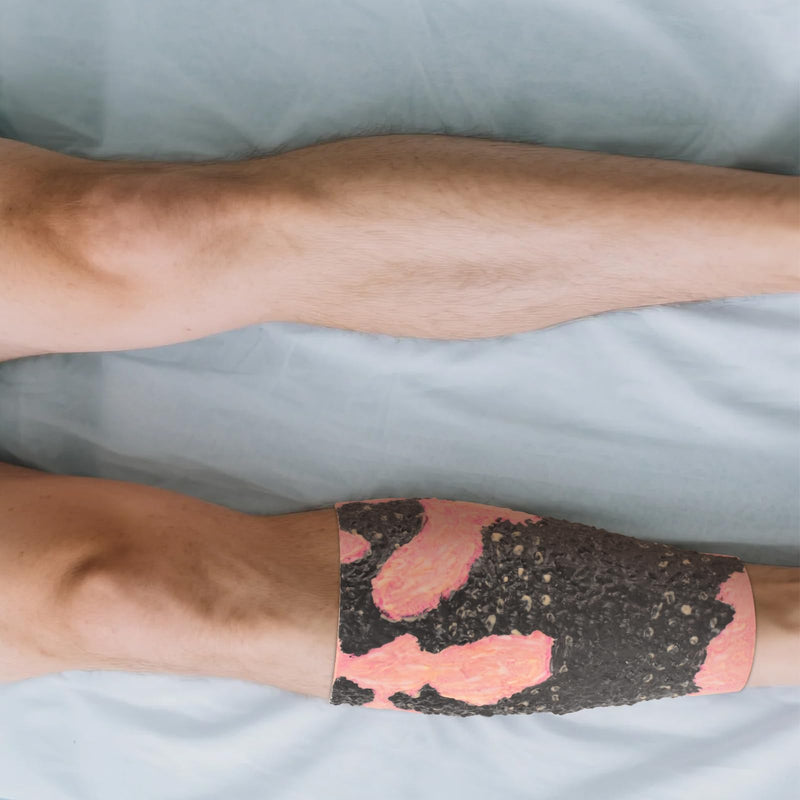 Burn Wound Packing Trainer, Burn Wound Care Model, Severe Leg Burn Wound for Demonstration