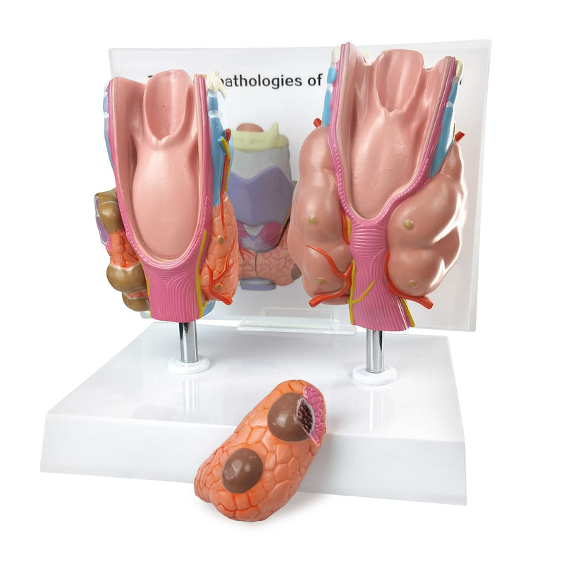 EVOTECH SCIENTIFIC Human Thyroid Pathology Anatomical Model - 4 Parts Life Size Medical Study Education Tool W/Stand and Manual for Demonstrating Goiter, Thyroid Cancer, and Graves’ Disease