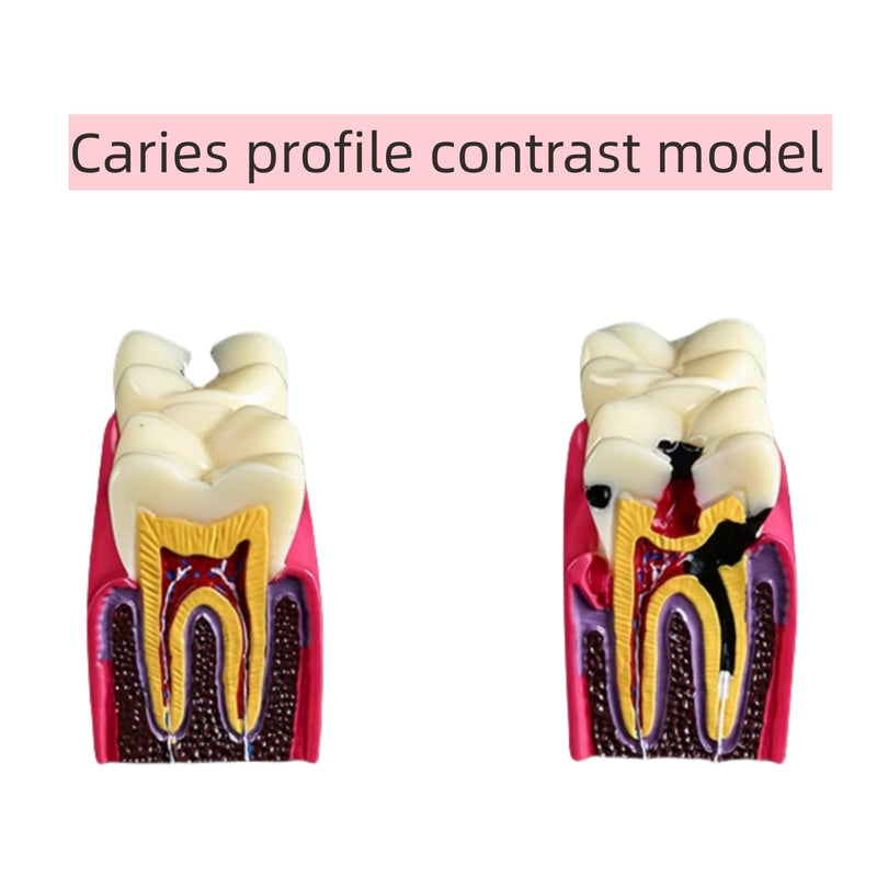 6 Times Dental Caries Model Teaching Typodont Tool for Dentists, Patients, Teachers and Students Studying and Researching (Teeth Removal) Teeth Removal
