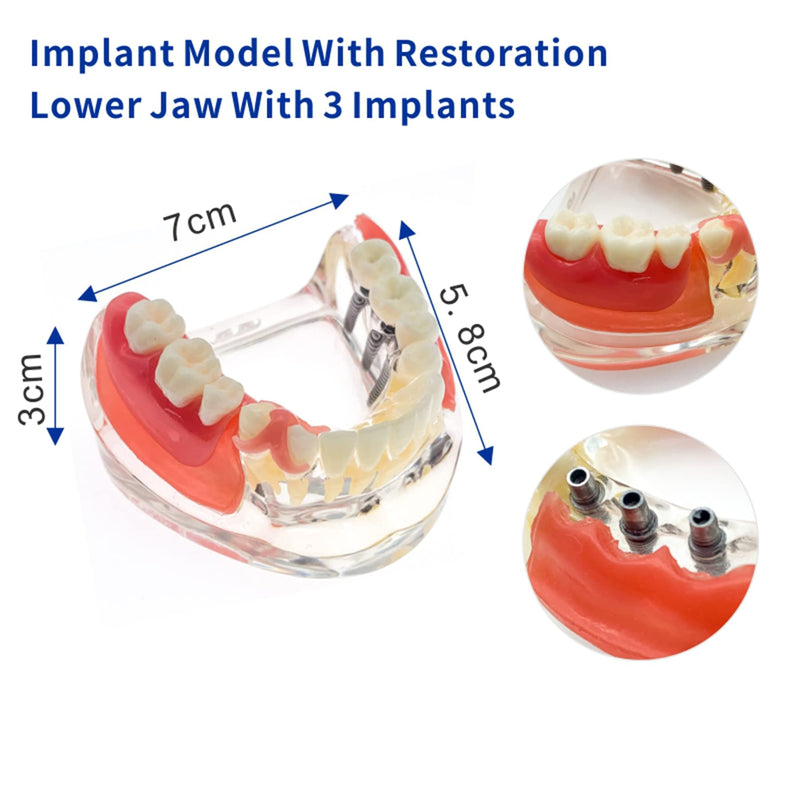Dental Implant Typodont Restoration Teeth Model M6006 Overdenture 3 Implants Bridge Inferior Lower Treatment Demo for Study Teach