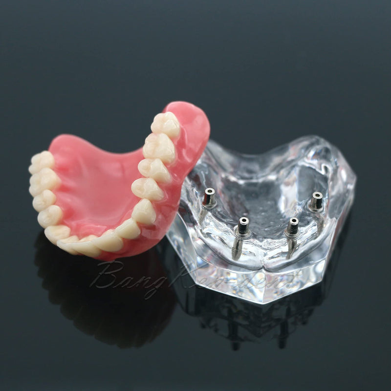 Dental Implant Typodont Restoration Teeth Model M6001 Clear Overdenture 4 Implants Superior Upper Demo for Study Teach