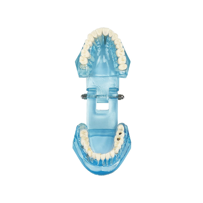 Transparent Disease Teeth Model, YOUYA DENTAL Transparent Dental Implant Teeth Model Dentist Standard Disease Removable Tooth Pathological Teaching Model(Blue)
