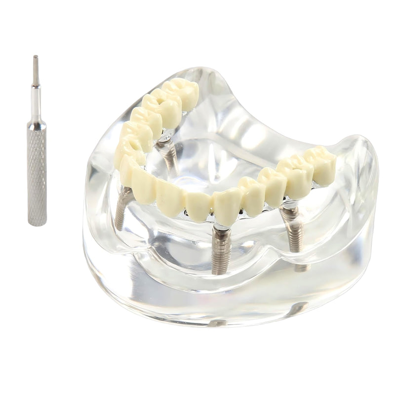 Dental Overdenture Inferior Model 4 Implants Upper Jaw Removable Demo Model | For Dentist Education and Study