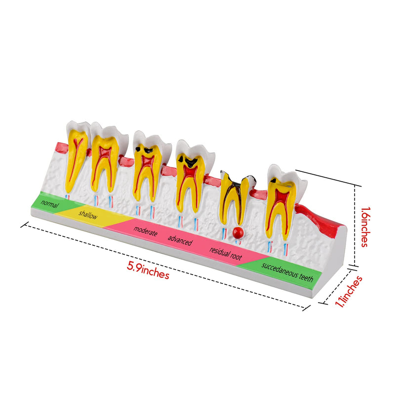 Dental Caries Developing Model, Dental Teeth Model for Dental Tooth Anatomy Study, Doctor-Patient and Oral Care Education Developing Decay Model