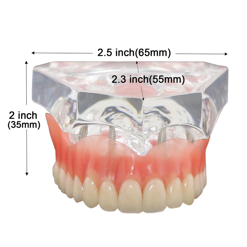Dental Implant Typodont Restoration Teeth Model M6001 Clear Overdenture 4 Implants Superior Upper Demo for Study Teach