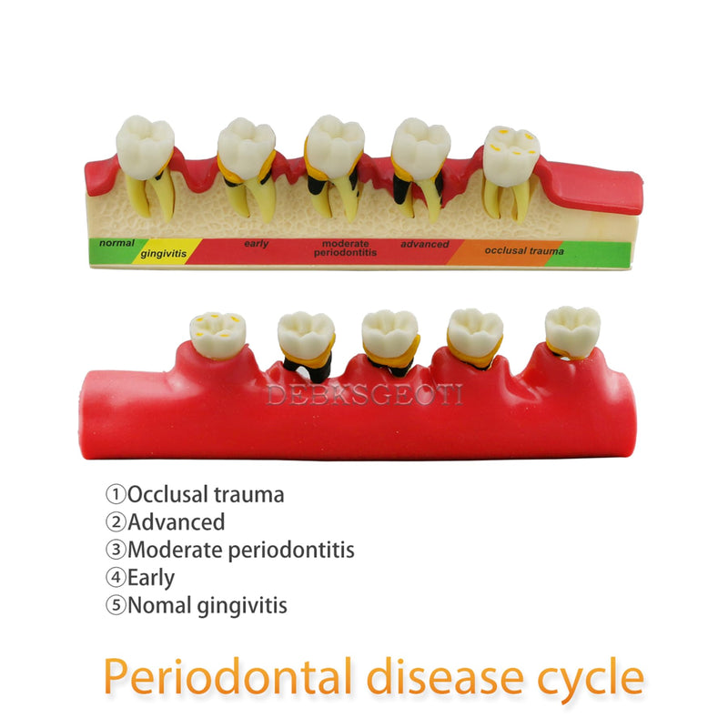 Dental Typodont Teeth Model M4010 Demonstrates The Progress of Periodontal Disease Category Pathology Dissect Teaching Study Demo