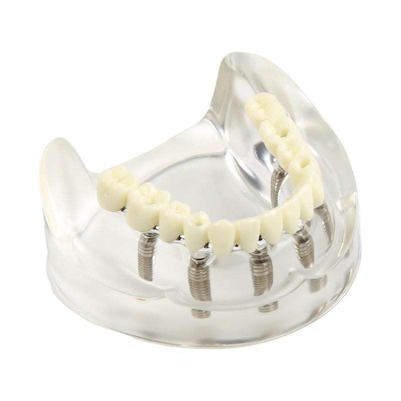 Dental Implant Model Transparent Upper Jaw with 6 Implants Removable Screws | Overdenture Restoration, Dental School Teaching Lab Demo, Patient Education