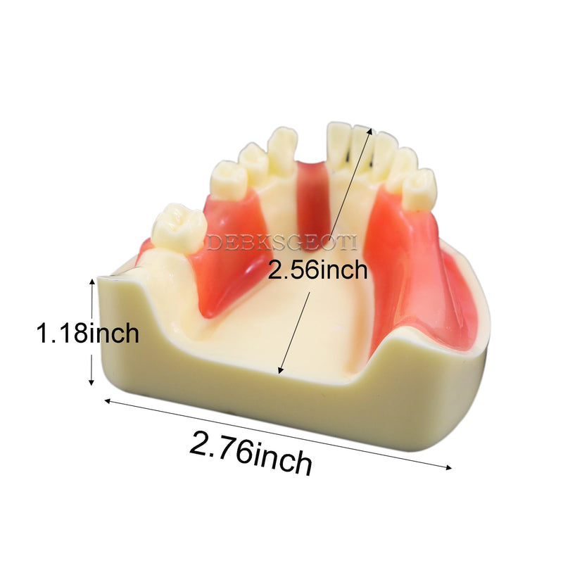 Dental Implant Typodont Practice Teeth Model Lower Jaw Overdenture Soft Gingiva Restoration Demo for Study Teach (M2004)