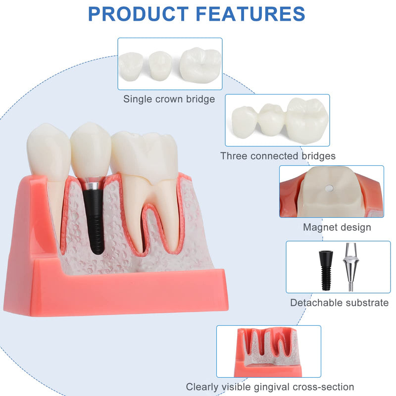 Dental Implant Model - Implant Vs Bridge Dental Model 4 Times Removable Analysis Crown Bridge Demonstration Teeth Model