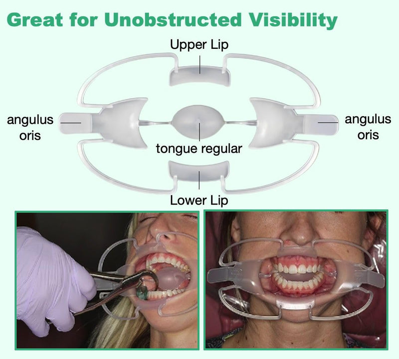 Multi-Function Tongue Retractor Cheek Retractor Lip Retractor More Views for Teeth Whitening/Dental Photography Sugical Mouth Openner (M) 2bdent