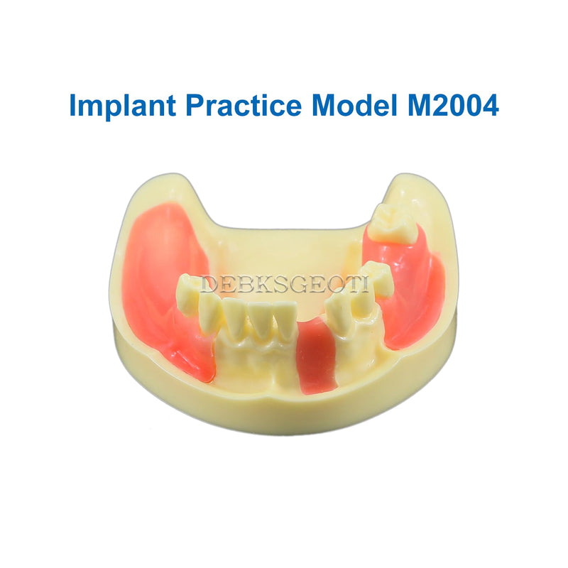 Dental Implant Typodont Practice Teeth Model Lower Jaw Overdenture Soft Gingiva Restoration Demo for Study Teach (M2004)