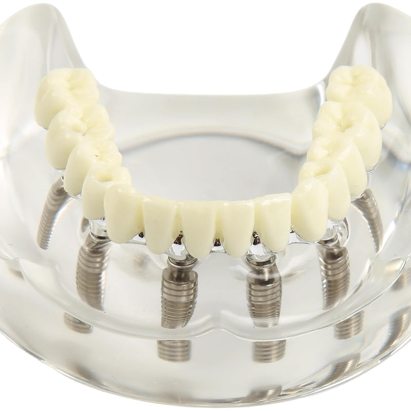 Dental Implant Model Transparent Upper Jaw with 6 Implants Removable Screws | Overdenture Restoration, Dental School Teaching Lab Demo, Patient Education