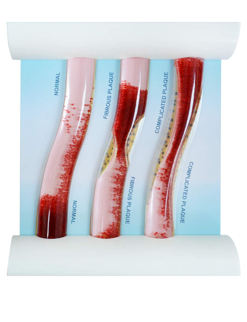 SimCoach Low-Density Lipoprotein LDL Blood Vessel Model for Medical Patient Doctor Teaching
