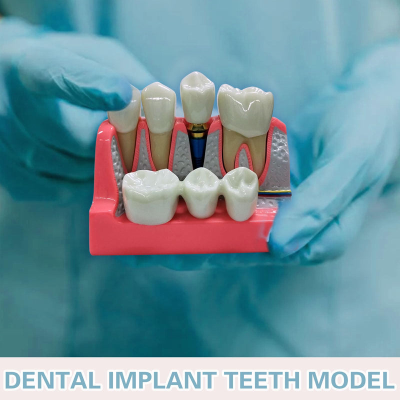 Dental Implant Model 4 Times Implant Teeth Model, Removable Dental Crown Bridge Model, Dental Implant Training Kit for Patient Education 4 teeth