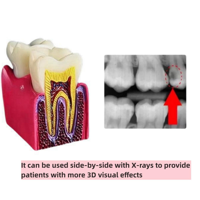 6 Times Dental Caries Model Teaching Typodont Tool for Dentists, Patients, Teachers and Students Studying and Researching (Teeth Removal) Teeth Removal