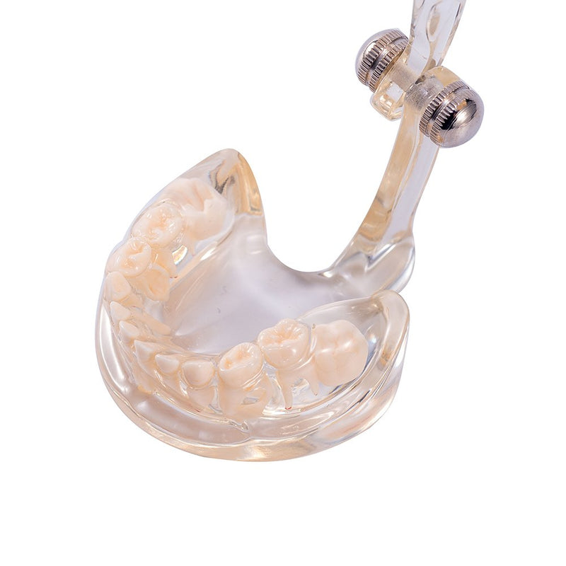 SNAWOP Dental Pathology Model Pediatric Teeth Model Clear Mixed Age Kids Disease Tooth Model
