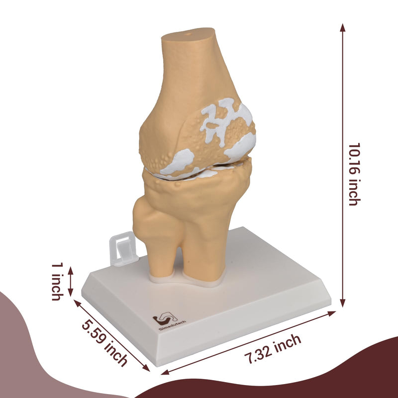 1:1 Osteoarthritis Knee Model for Orthopedic Patient Education | Shows Knee Arthritis;Explains Cartilage Wear;Magnetic Demo Design;For Clinic Teaching;Patient Education Aid