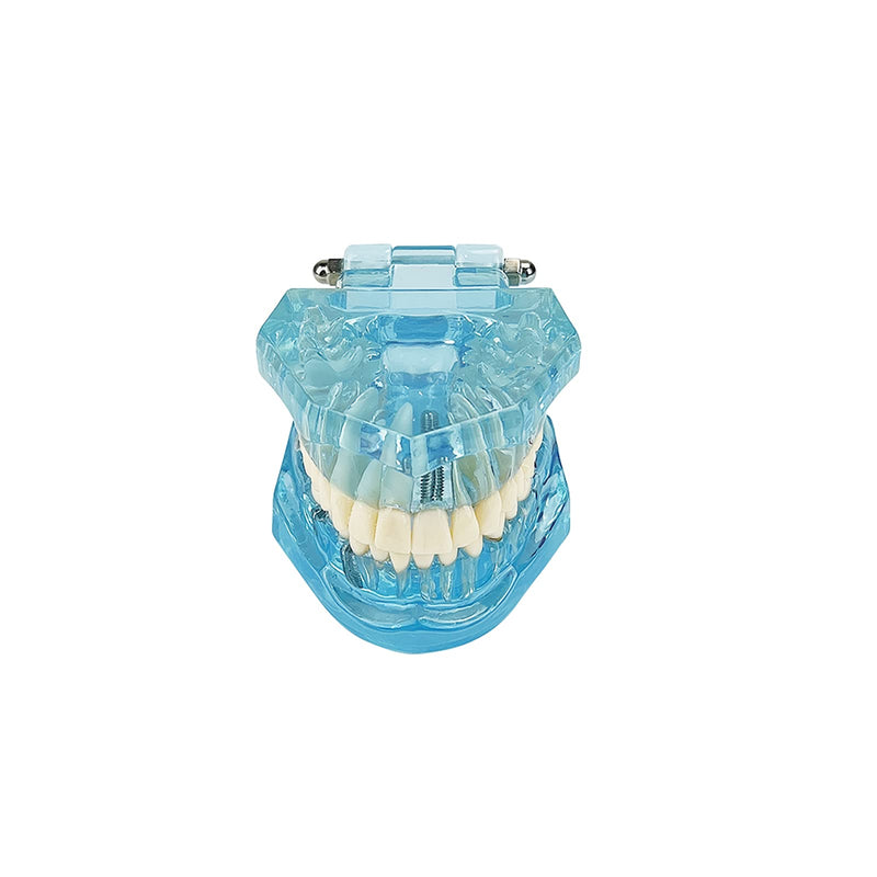 Transparent Disease Teeth Model, YOUYA DENTAL Transparent Dental Implant Teeth Model Dentist Standard Disease Removable Tooth Pathological Teaching Model(Blue)