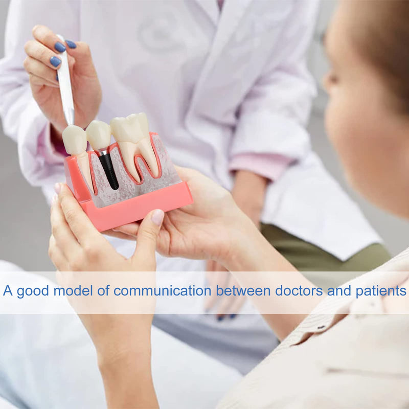 Dental Implant Model - Implant Vs Bridge Dental Model 4 Times Removable Analysis Crown Bridge Demonstration Teeth Model
