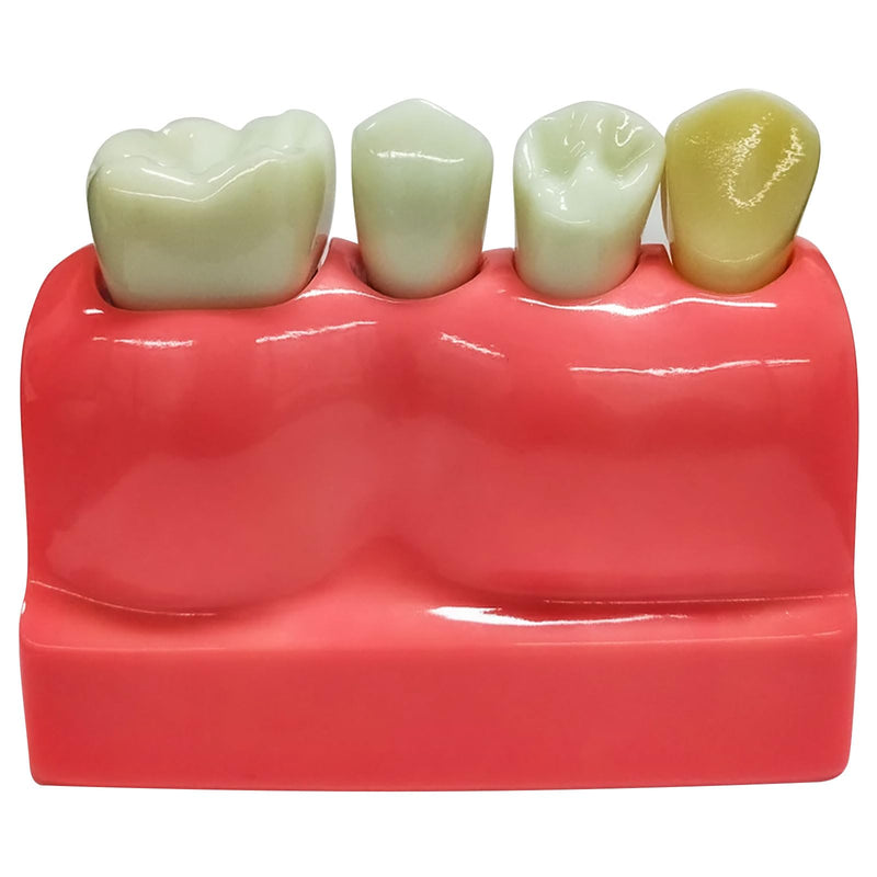 Dental Implant Model 4 Times Implant Teeth Model, Removable Dental Crown Bridge Model, Dental Implant Training Kit for Patient Education 4 teeth
