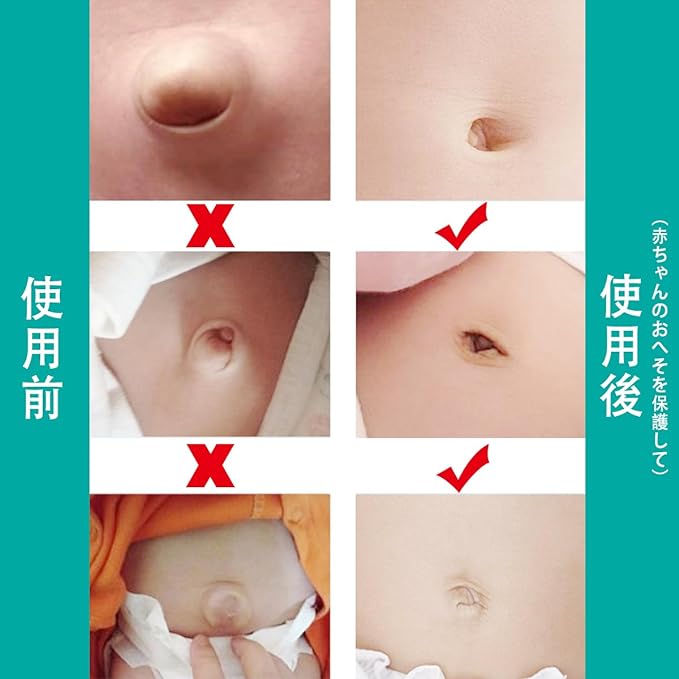 [Kisymear] 2 Pieces Baby Umbilical Hernia Belt Infant Abdominal Binder Baby Navel Truss Support Newborn Belly Belt Baby Kids Infant (Pink) - NewNest Australia