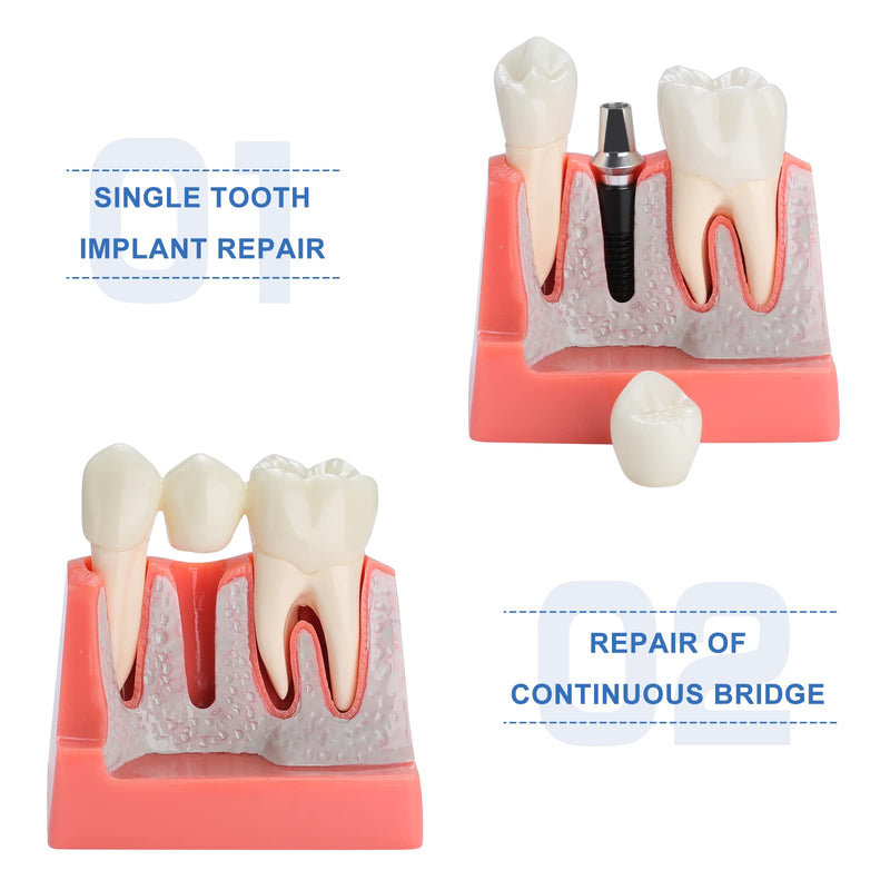 Dental Implant Model - Implant Vs Bridge Dental Model 4 Times Removable Analysis Crown Bridge Demonstration Teeth Model