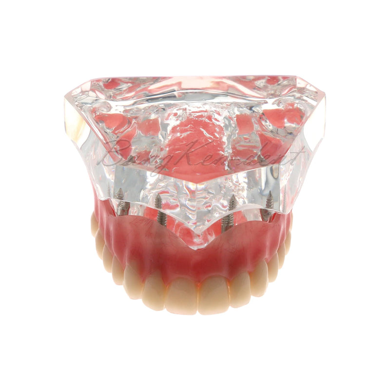 Dental Implant Typodont Restoration Teeth Model M6001 Clear Overdenture 4 Implants Superior Upper Demo for Study Teach