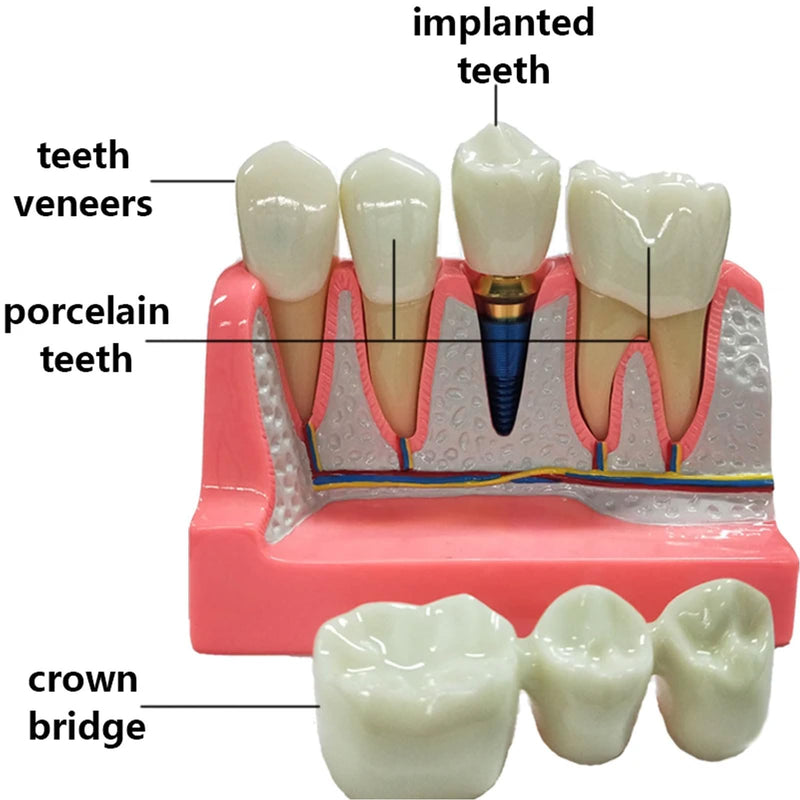 Dental Implant Model 4 Times Implant Teeth Model, Removable Dental Crown Bridge Model, Dental Implant Training Kit for Patient Education 4 teeth