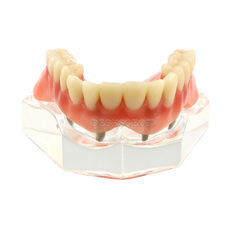 Dental Implant Typodont Restoration Teeth Model M6001 Clear Overdenture 4 Implants Superior Upper Demo for Study Teach
