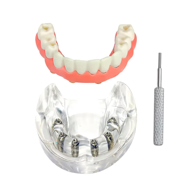 Dental Overdenture Inferior Model, 6 Nail Dental Implant Model Removable Demo Model for Researching Medical Dentist Teaching Studying