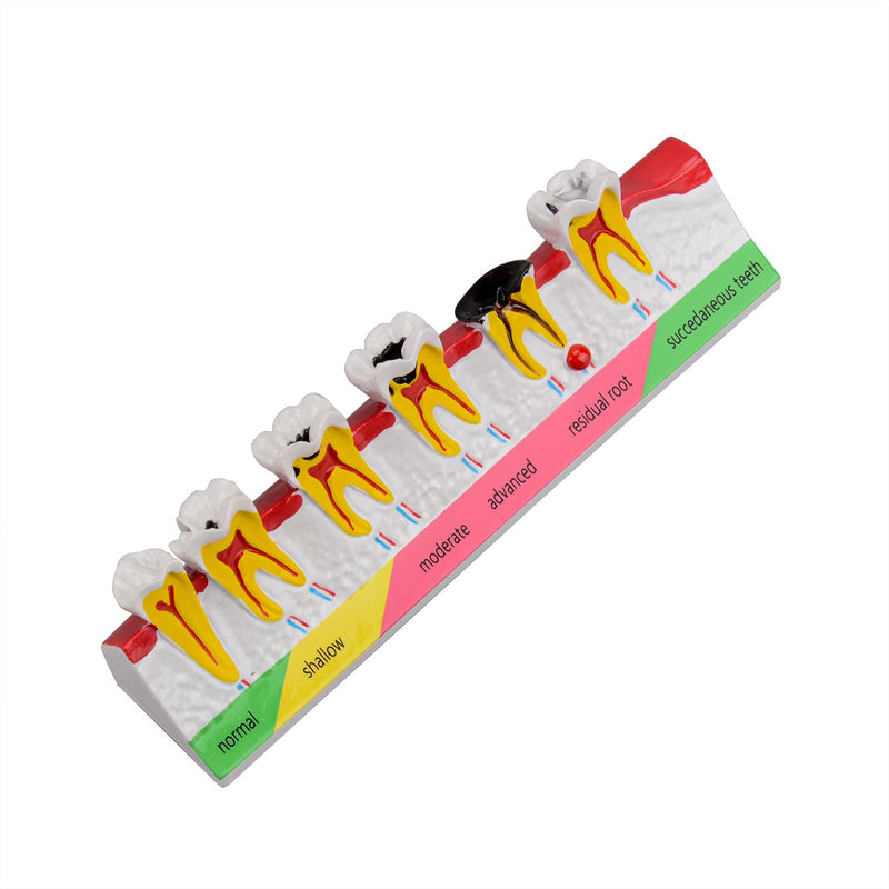 Dental Caries Developing Model, Dental Teeth Model for Dental Tooth Anatomy Study, Doctor-Patient and Oral Care Education Developing Decay Model