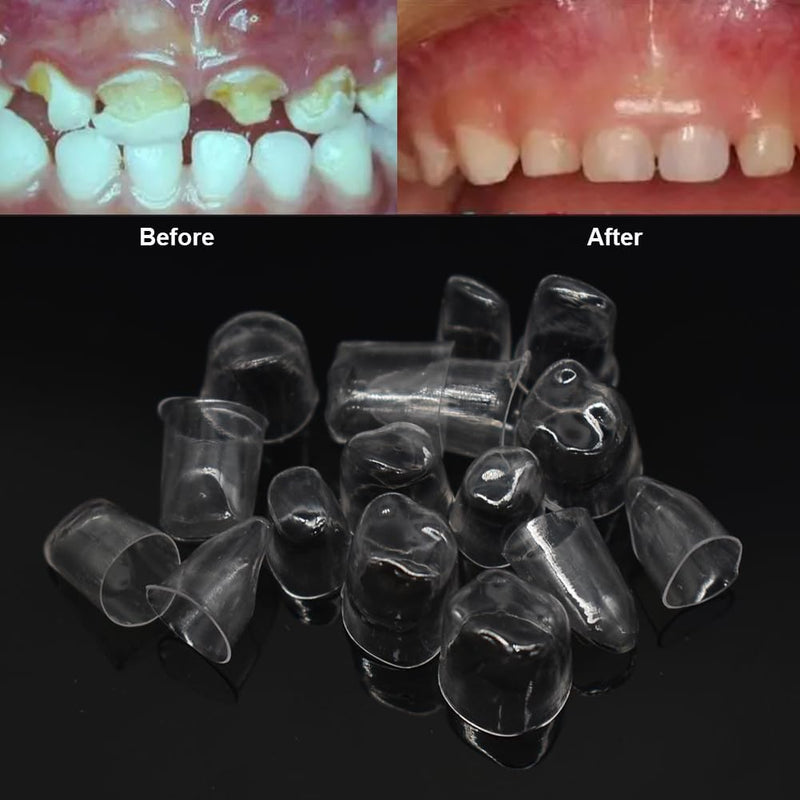 64 Pcs Deciduous Transparent Crowns Kit,Dental Temporary Crown for Anterior Teeth,Dental Materials