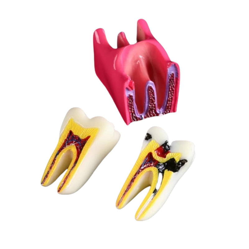 6 Times Dental Caries Model Teaching Typodont Tool for Dentists, Patients, Teachers and Students Studying and Researching (Teeth Removal) Teeth Removal