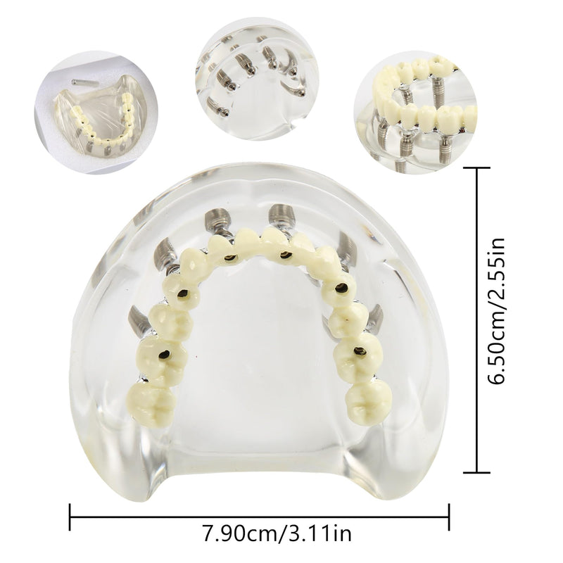 Dental Implant Model Transparent Upper Jaw with 6 Implants Removable Screws | Overdenture Restoration, Dental School Teaching Lab Demo, Patient Education