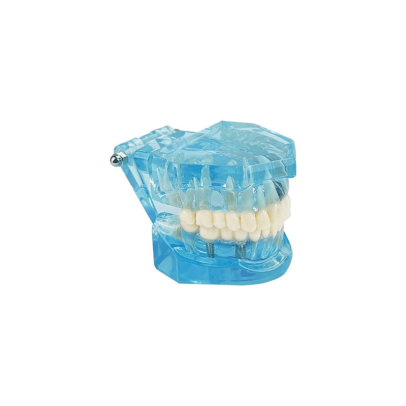 Transparent Disease Teeth Model, YOUYA DENTAL Transparent Dental Implant Teeth Model Dentist Standard Disease Removable Tooth Pathological Teaching Model(Blue)