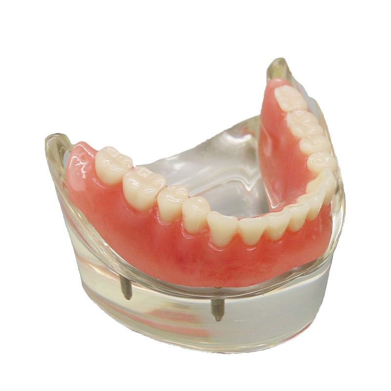 Dental Model Overdenture Inferior 4 Implants Demo for Teaching and Studying