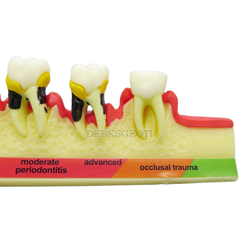 Dental Typodont Teeth Model M4010 Demonstrates The Progress of Periodontal Disease Category Pathology Dissect Teaching Study Demo