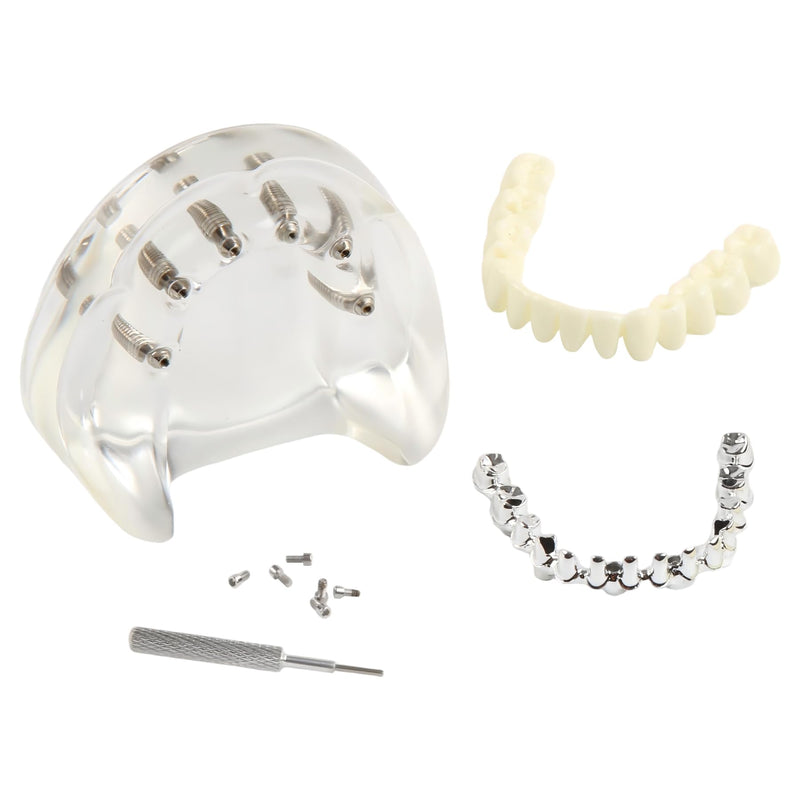 Dental Implant Model Transparent Upper Jaw with 6 Implants Removable Screws | Overdenture Restoration, Dental School Teaching Lab Demo, Patient Education