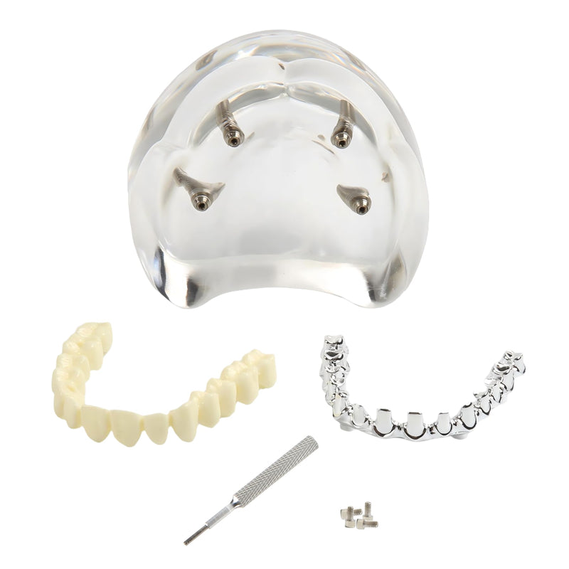 Dental Overdenture Inferior Model 4 Implants Upper Jaw Removable Demo Model | For Dentist Education and Study