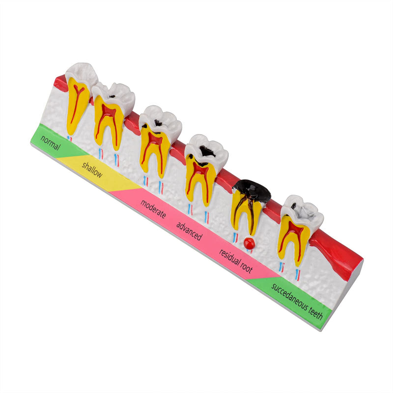 Dental Caries Developing Model, Dental Teeth Model for Dental Tooth Anatomy Study, Doctor-Patient and Oral Care Education Developing Decay Model