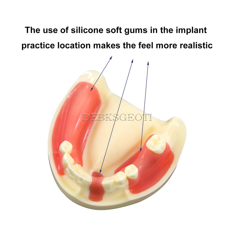 Dental Implant Typodont Practice Teeth Model Lower Jaw Overdenture Soft Gingiva Restoration Demo for Study Teach (M2004)
