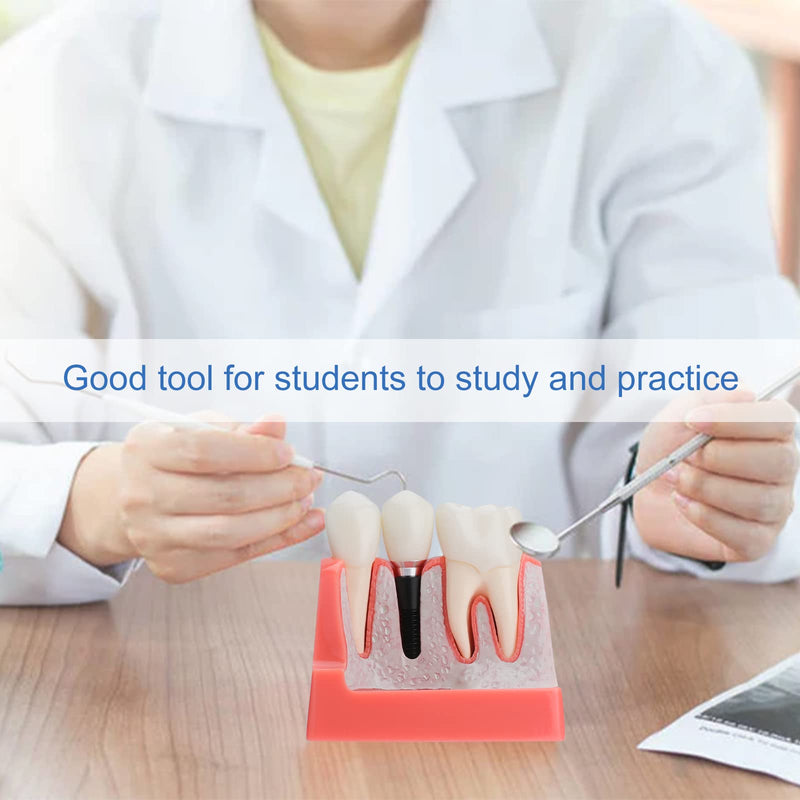 Dental Implant Model - Implant Vs Bridge Dental Model 4 Times Removable Analysis Crown Bridge Demonstration Teeth Model