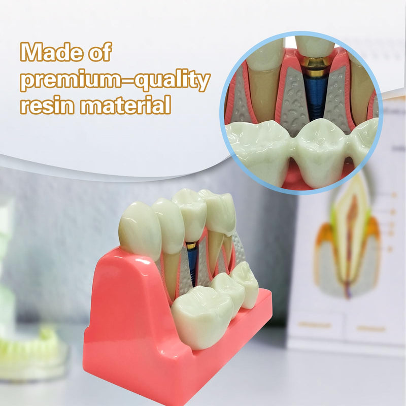 Dental Implant Model 4 Times Implant Teeth Model, Removable Dental Crown Bridge Model, Dental Implant Training Kit for Patient Education 4 teeth