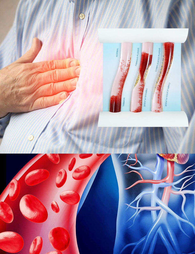 SimCoach Low-Density Lipoprotein LDL Blood Vessel Model for Medical Patient Doctor Teaching