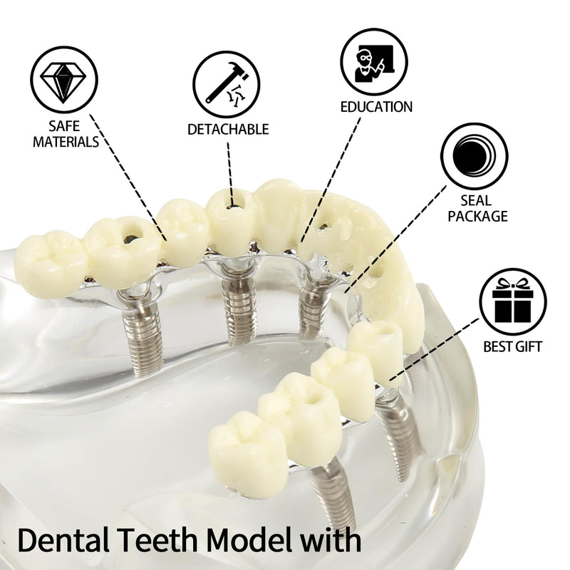 Dental Implant Model Transparent Upper Jaw with 6 Implants Removable Screws | Overdenture Restoration, Dental School Teaching Lab Demo, Patient Education