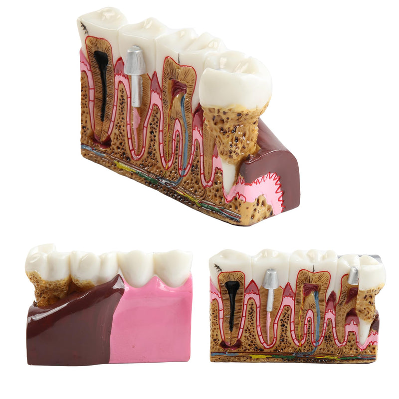 Dental Caries Tooth Anatomy Model Tooth Pathology Models | Caries Evolution Model, Comprehensive Structure Teaching, Oral Study
