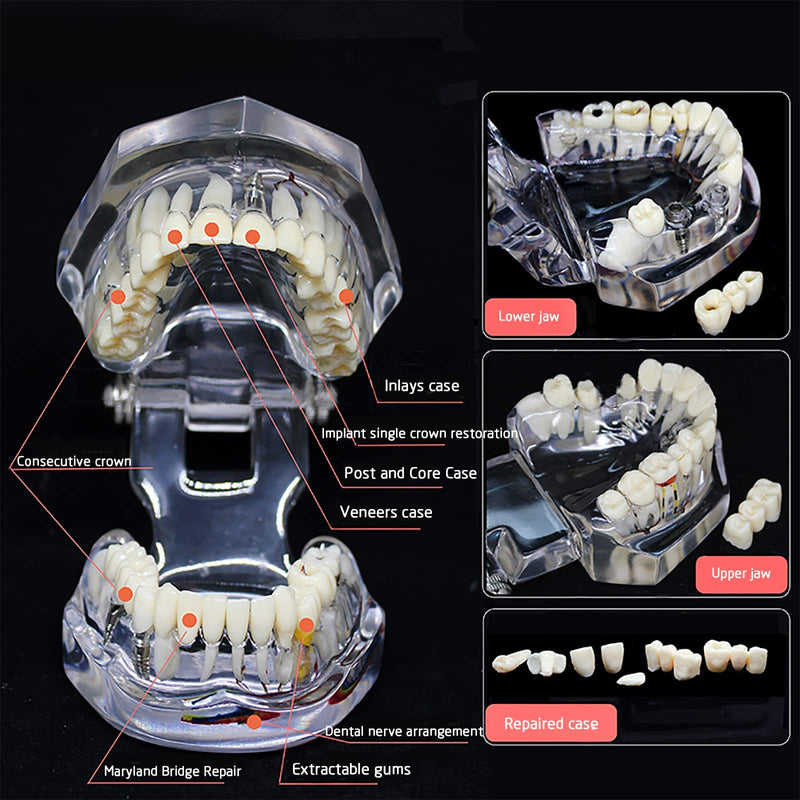 Neural Repair Dental Model Implant Disease Teeth Model Dentist Standard Pathological Removable Teeth Teaching Model for Dentist School Educating Learning