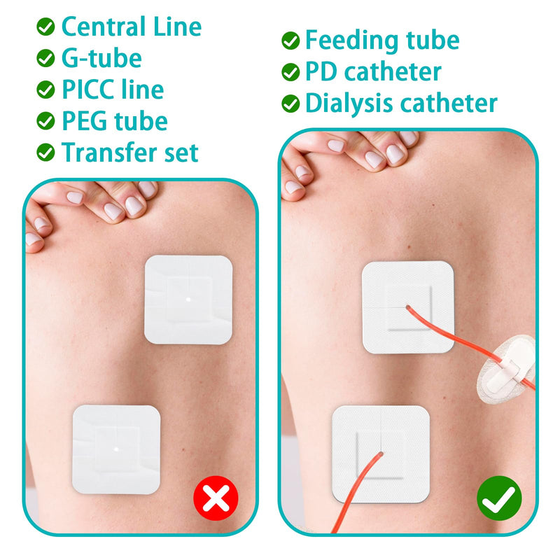 15 Pcs Split Drain Feeding Tube Adhesive Bandages, Peg G J Supra-Pubic Incision Bordered Guaze Pad with 10 Alcohol Cotton Pads, Sterile Drain Patch Supplies Island Dressing(5.9×5.51inch)