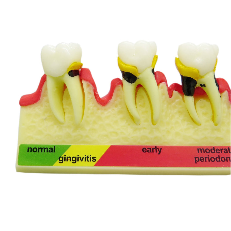 Dental Typodont Teeth Model M4010 Demonstrates The Progress of Periodontal Disease Category Pathology Dissect Teaching Study Demo